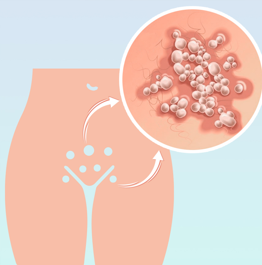 Lazerle Genital Siğil Tedavisi